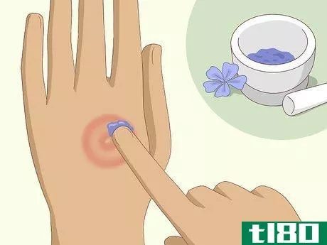 Image titled Get Rid of Ringworm Naturally Step 3