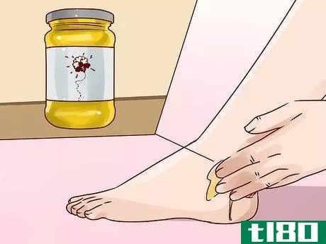 Image titled Get Rid of Ringworm Scars Step 5