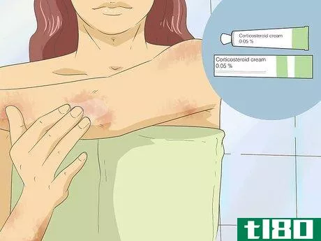 Image titled Get Rid of Psoriasis Step 1