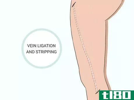 Image titled Get Rid of Varicose Veins Step 5