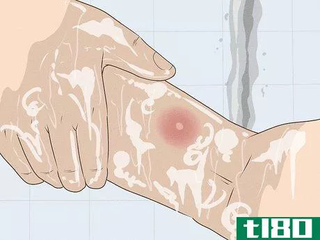 Image titled Get Rid of a Mosquito Bite Step 2