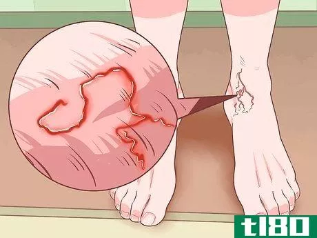 Image titled Get Rid of Hookworms When Infected Step 3
