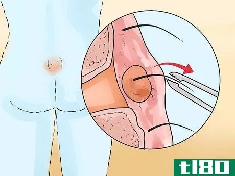 Image titled Get Rid of a Cyst Step 12