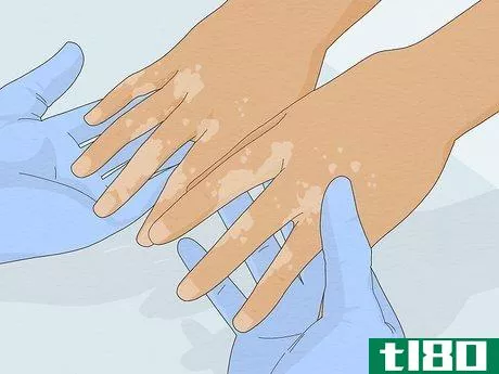 Image titled Get Rid of White Spots on the Skin Due to Sun Poisoning Step 7