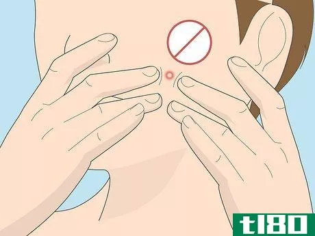 Image titled Get Rid of a Pimple Using Toothpaste Step 19