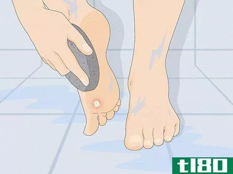 Image titled Get Rid of a Wart at the Bottom of Your Foot Step 2
