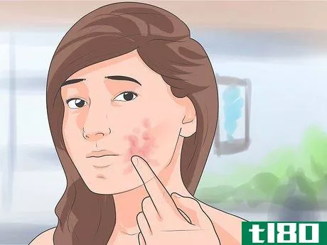 Image titled Get Rid of Hives on the Face Step 10
