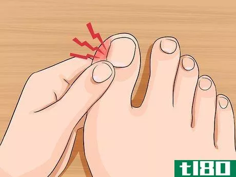 Image titled Relieve Ingrown Toe Nail Pain Step 2