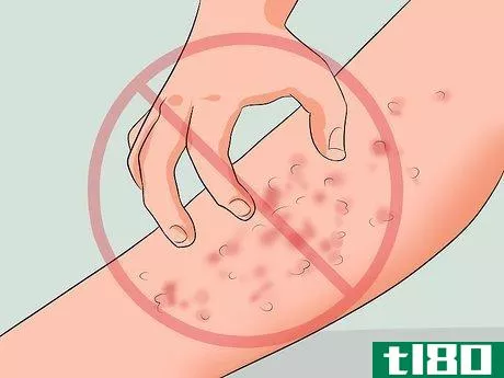 Image titled Get Rid of a Rash from Nair Step 8