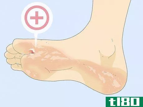 Image titled Get Rid of Foot Fungus Step 5