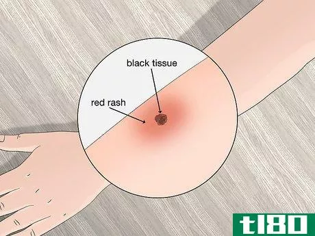 Image titled Identify Tick Bites Step 6