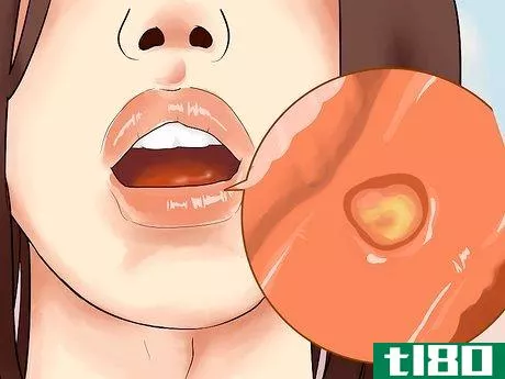 Image titled Heal Mouth Inflammation Step 1