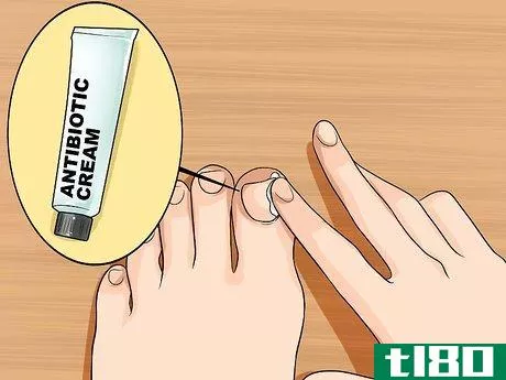 Image titled Relieve Ingrown Toe Nail Pain Step 18