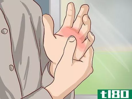 Image titled Know If Your Knuckle Is Broken Step 3
