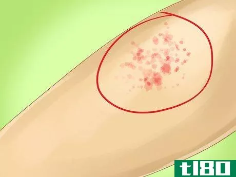 如何识别麻疹(identify measles)