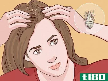 Image titled Get Rid of Lice Step 5