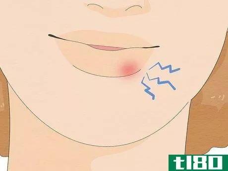Image titled Get Rid of a Cold Sore Fast Step 17