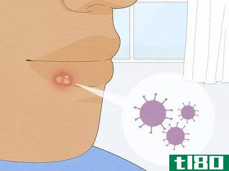 Image titled Get Rid of a Cold Sore Fast Step 18