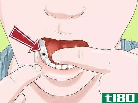 Image titled Know if Your Dental Fillings Need Replacing Step 5