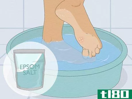 Image titled Get Rid of a Wart at the Bottom of Your Foot Step 1