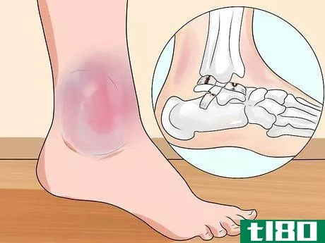 Image titled Know if You've Sprained Your Ankle Step 7