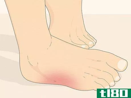 Image titled Know if You Have Neuropathy in Your Feet Step 3