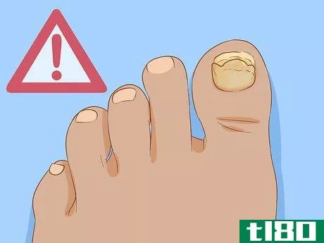 Image titled Help a Toenail Grow Back Quickly Step 15