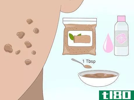 Image titled Get Rid of Acne Scars Fast Step 16