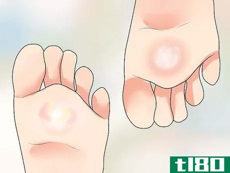 Image titled Know if You Have Athlete's Foot Step 4