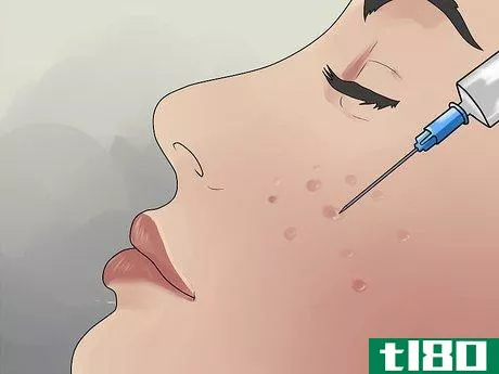 Image titled Get Rid of Cystic Acne Scars Step 10