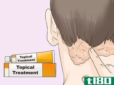 Image titled Get Rid of an Itchy Scalp Step 9