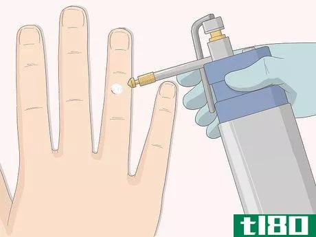 Image titled Get Rid of Warts Step 5