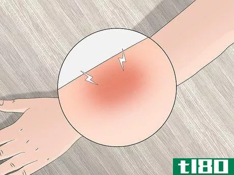 Image titled Identify Tick Bites Step 5