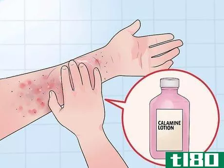Image titled Get Rid of Stress Hives Step 10