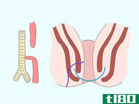 Image titled Heal a Fistula Step 16