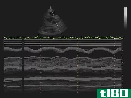 Image titled Interpret Echocardiograms Step 8