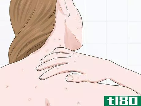 Image titled Know if You Need a Prescription Acne Treatment Step 5