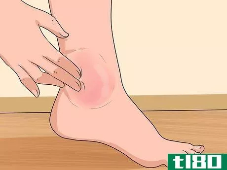 Image titled Know if You've Sprained Your Ankle Step 4