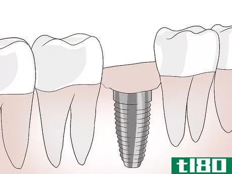 Image titled Know What to Expect when Getting a Tooth Implant Step 12