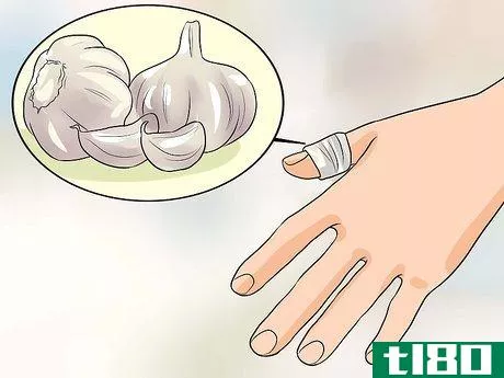 Image titled Get Rid of Warts on Fingers Step 7