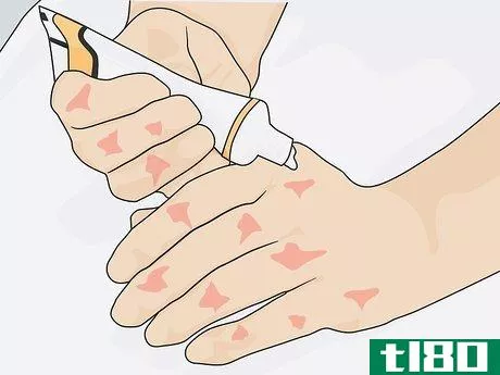 Image titled Help Control Psoriasis with Lifestyle Changes Step 16