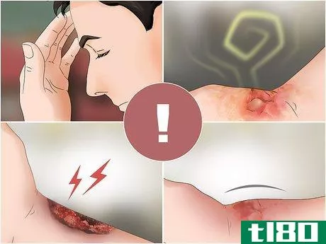 Image titled Heal Burns Fast Step 7