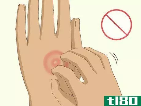 Image titled Get Rid of Ringworm Naturally Step 10