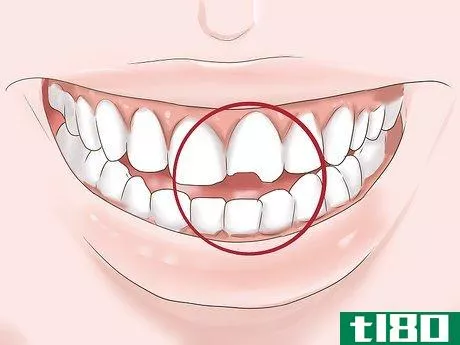 Image titled Know if Your Dental Fillings Need Replacing Step 9