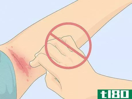 Image titled Heal Raw Skin Step 6