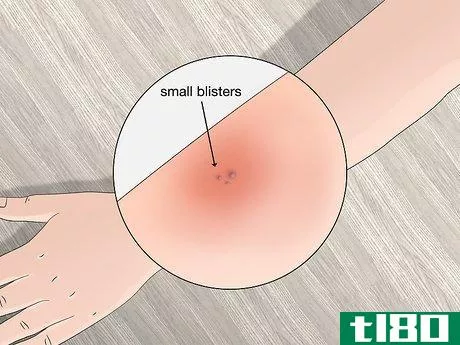 Image titled Identify Tick Bites Step 8