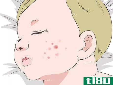 Image titled Get Rid of Baby Acne Step 7