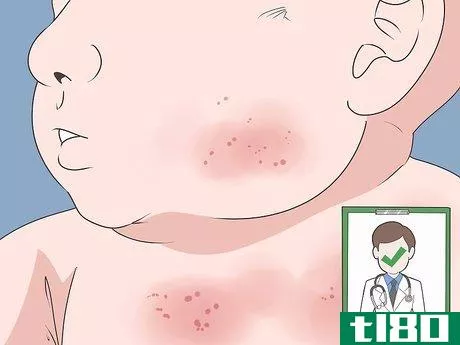 Image titled Get Rid of Baby Acne Step 9