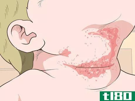 Image titled Identify and Treat Different Types of Diaper Rash Step 7