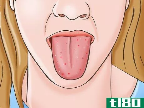 Image titled Know if You Have Oral Thrush Step 1